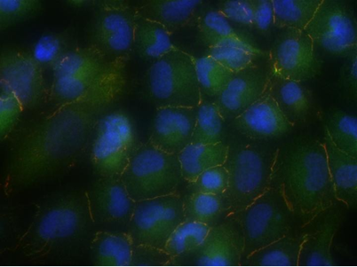 Cancer&nbsp;Res：鳞状肺癌中肿瘤抑制基因失活