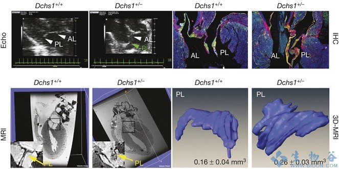 Nature：发现第一个致二尖瓣脱垂的基因突变