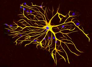 Neurology：科学家发现与常见致死脑瘤相关的免疫基因