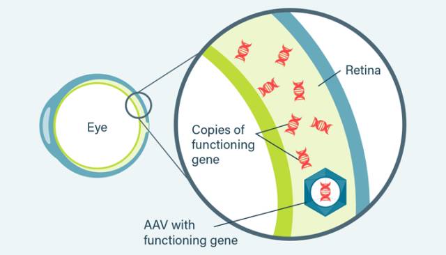 3期临床结果优秀，可治疗“失明”的基因疗法或将上市