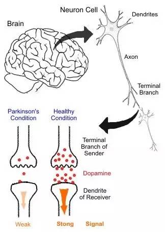 基因疗法提高多巴胺水平，帕金森创新药要来了?