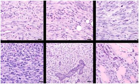 Oncogene：发现促进化生性乳腺癌产生的关键性基因