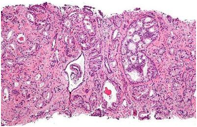 Nature：揭示出局限性前列腺癌基因指纹