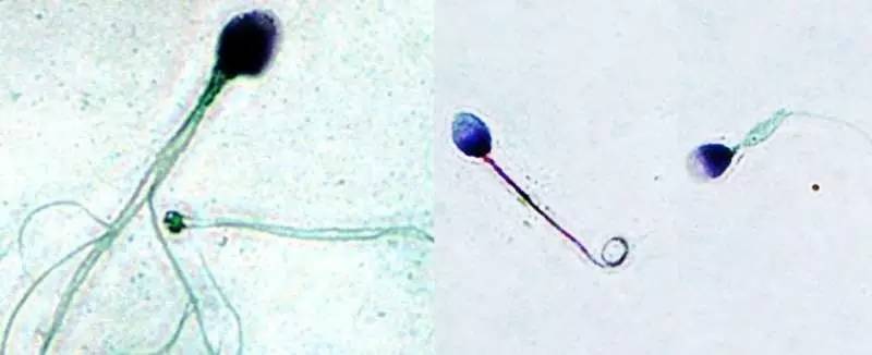 男性不育的遗传学病因——不得不重视的基因突变