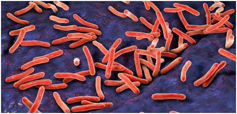 J&#160;Clin&#160;Microbiol：新的基因测试方法一天内检测出肺结核