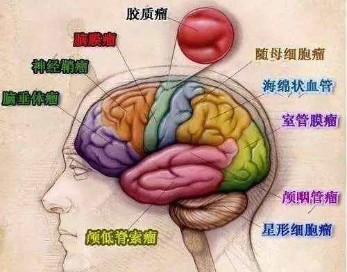 神经科学家发现控制脑瘤增长的关键基因