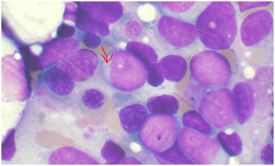 Leukemia：鉴定出与34种AML白血病亚群相关联的基因突变