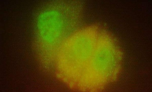 Oncotarget：新型乳腺癌药物能击败诱发多种类型癌症的癌基因-Ras