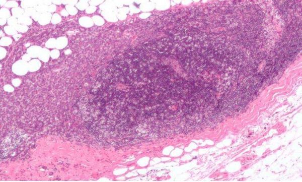 PLoS&nbsp;Comput&nbsp;Biol：乳腺癌细胞的蛋白互作网络或能改变基因的表达情况