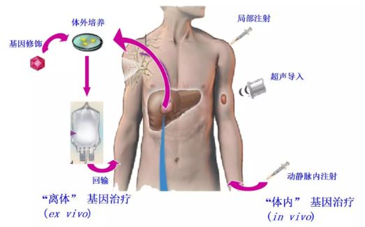 基因治疗的国内外研究进展。