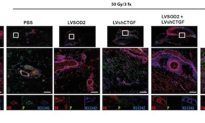 Sci&#160;Trans&#160;Med：病毒基因疗法能够提高癌症治疗后乳房重构的效果