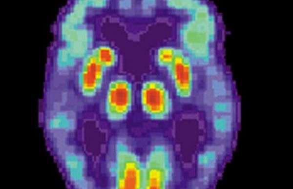 Mol&nbsp;Psych：科学家鉴别出能促进个体患阿尔兹海默病的新型风险基因