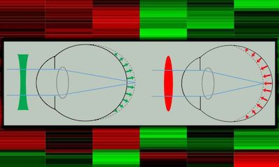 PLoS&#160;Biol：新研究揭示导致近视发生的基因