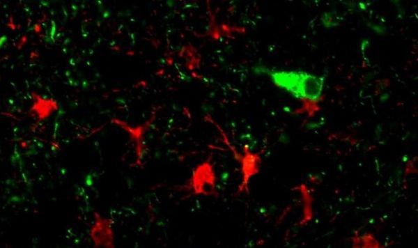 Nat&#160;Med：科学家鉴别出新型痴呆症风险基因