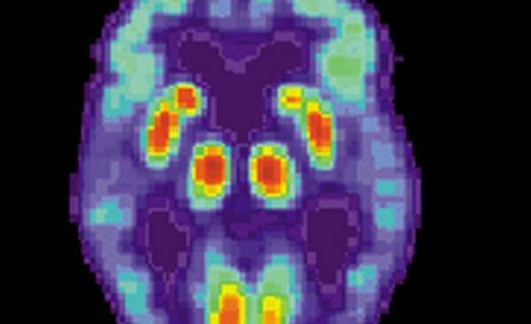 Nat&nbsp;Neurosci：揭秘阿尔兹海默病患者如何失去对基因活性的控制？