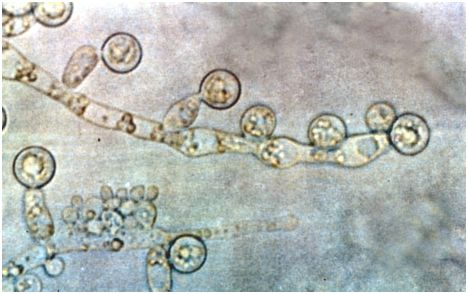 Science子刊：揭示基因SIGLEC15是复发性外阴阴道念珠菌病的易感性因子