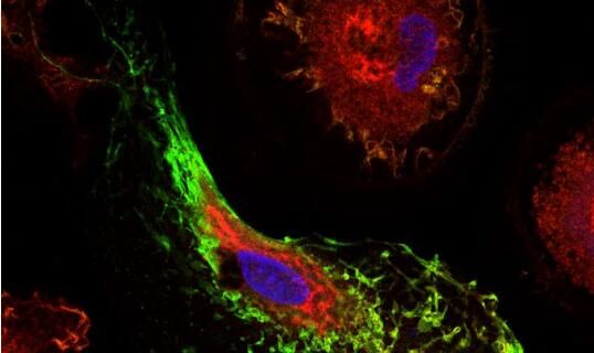 Sci&nbsp;Transl&nbsp;Med：科学家鉴别出与阿尔兹海默病发病风险相关的关键基因